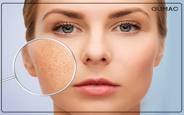 Cách make up che sẹo rỗ