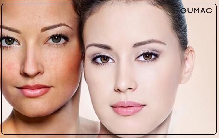 Cách trang điểm che khuyết điểm tàn nhang
